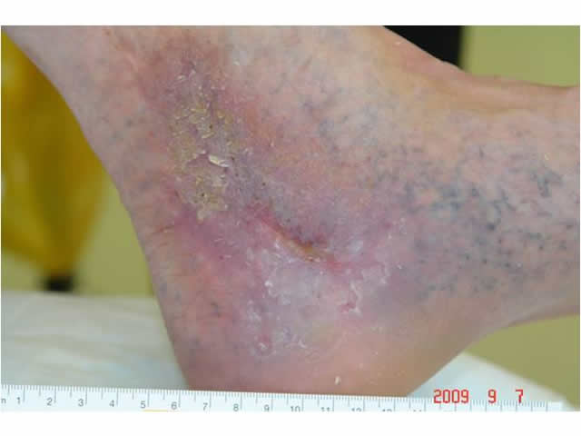 M3 05 Telegectasia or ankle flare  