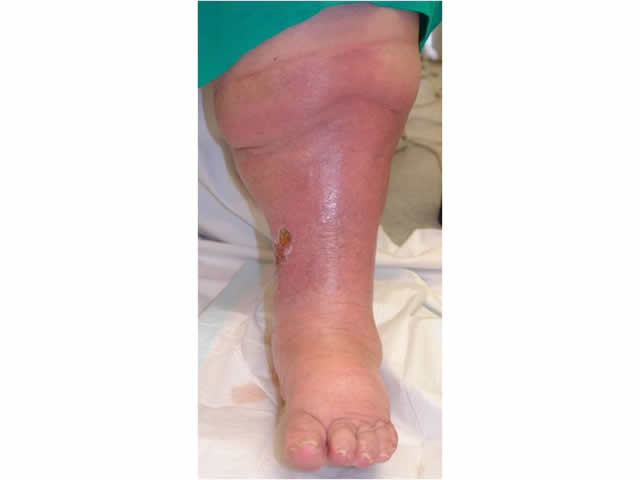 M3 07 Swelling of the lower leg  