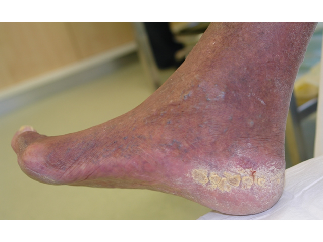 Promoting Healthy Skin - 5. Diabetic Foot Ulcers - A. Assessment