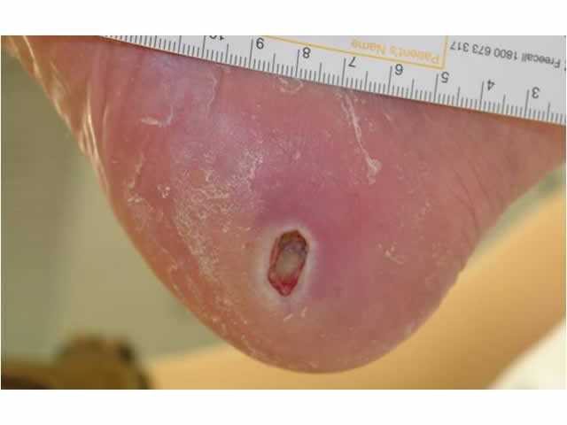 M5 03 Deep ulcer on side of foot