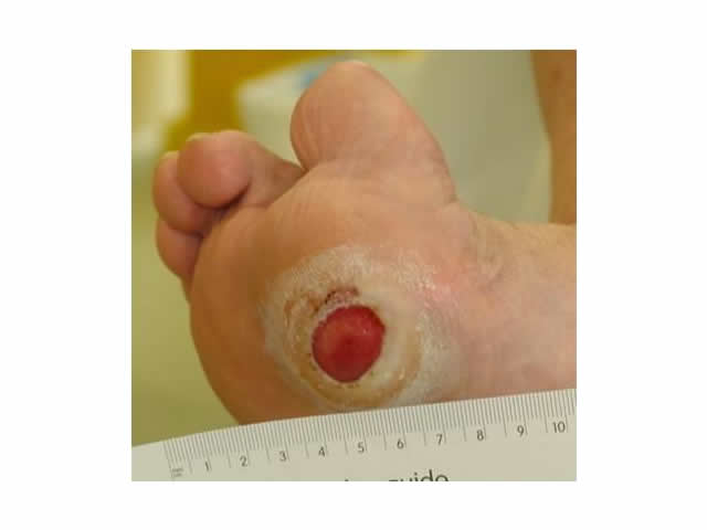 M5 06 Callous surrounding wound