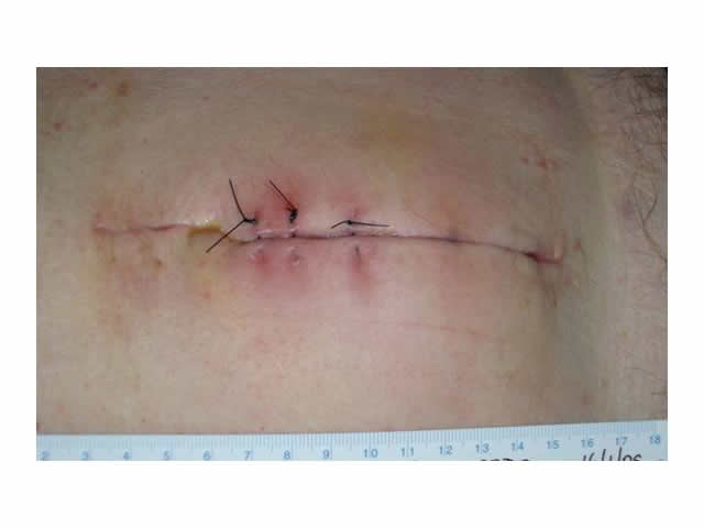 M7 06 Surgical incisions