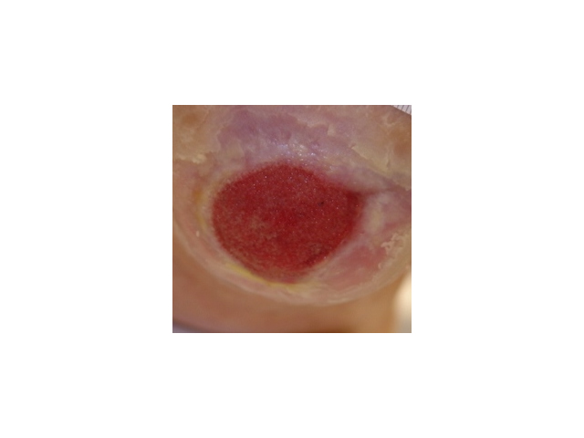 Epithelial Tissue Wound