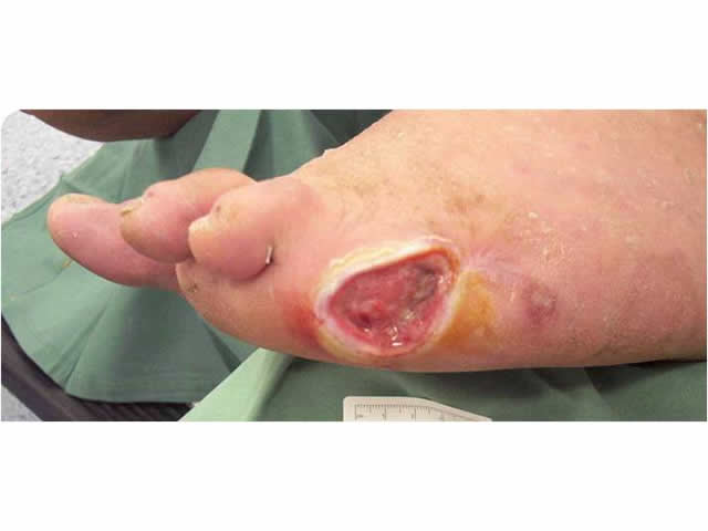 M7 18 Diabetic foot ulcer