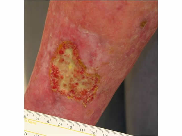 M7 21 Yellow sloughy wound