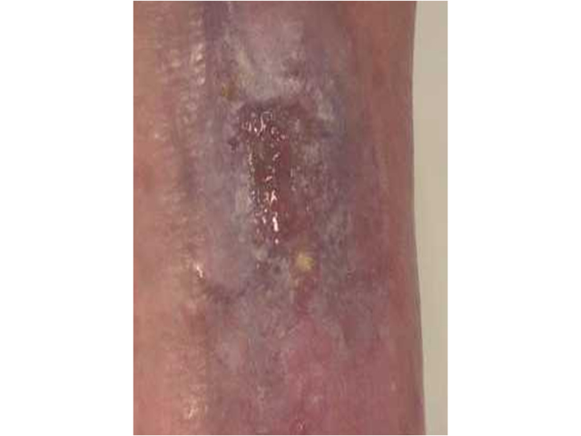 M7 23 Pink epithelialising wound