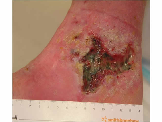 M7 24 Green infected tissue