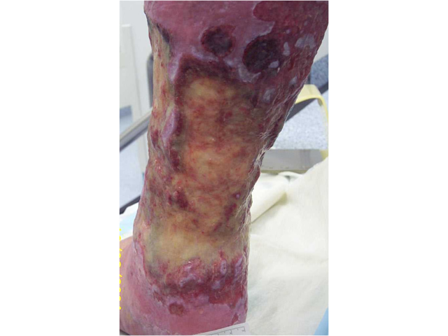 M7 25 Green infected wound
