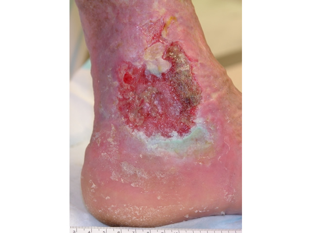 M7 27 Wound infection