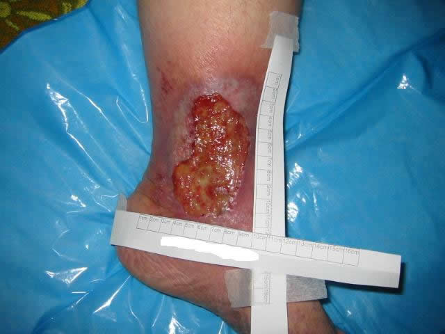M8 01 Ulcer located on ankle